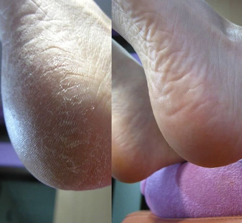 Foto do talón do pé antes e despois de usar a crema Zenidol