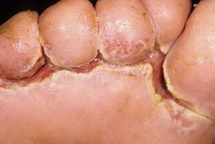 síntomas do fungo das unhas