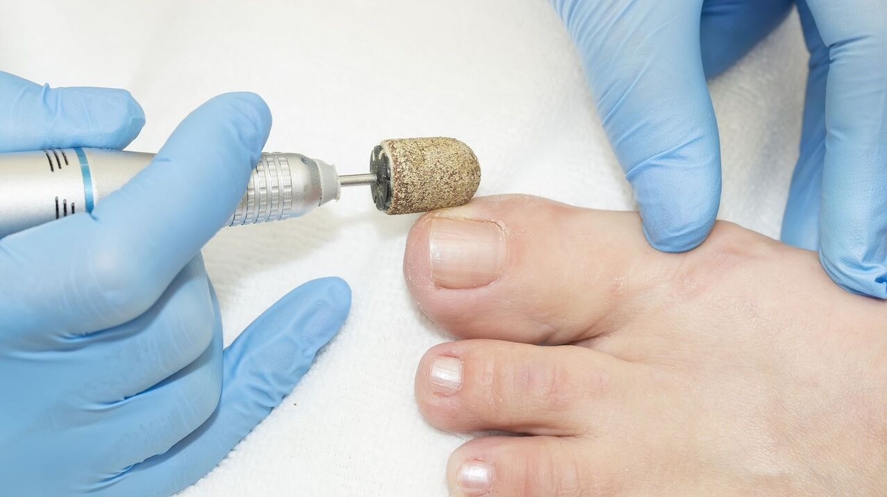 tratamento de hardware de fungos nas unhas dos pés