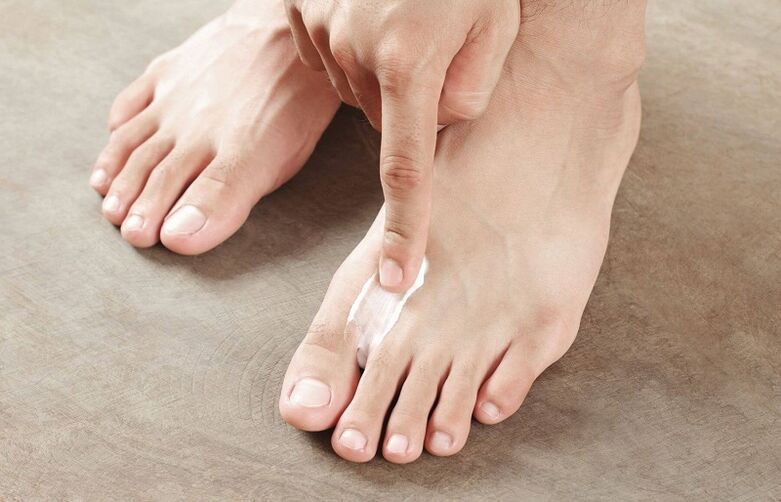 pomada para o tratamento de fungos nas unhas dos pés
