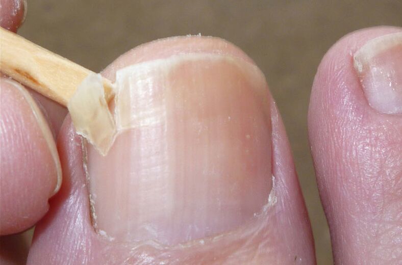 As uñas danadas son un factor de risco para a infección por fungos