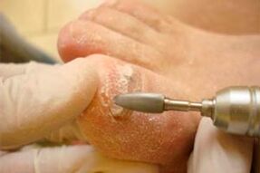 Corte mecánico da placa das uñas