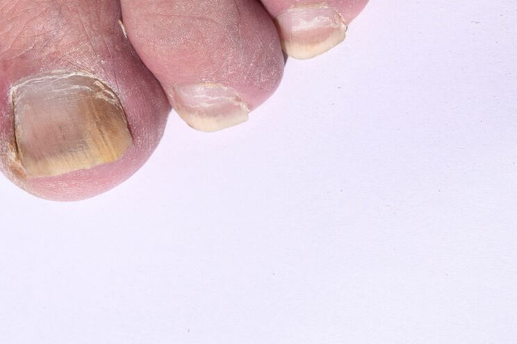 A etapa inicial da micose das uñas nas pernas