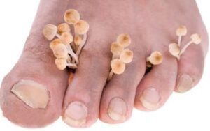 Onicomicosis das uñas dos pés