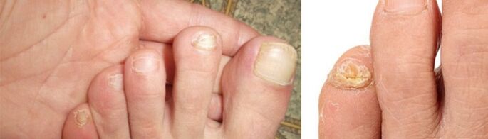 foto de manifestacións de fungos nas uñas dos pés