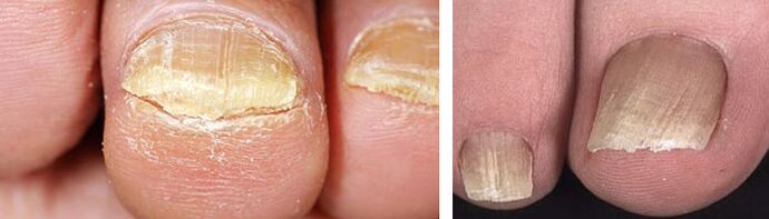 danos nas uñas cunha infección por fungos