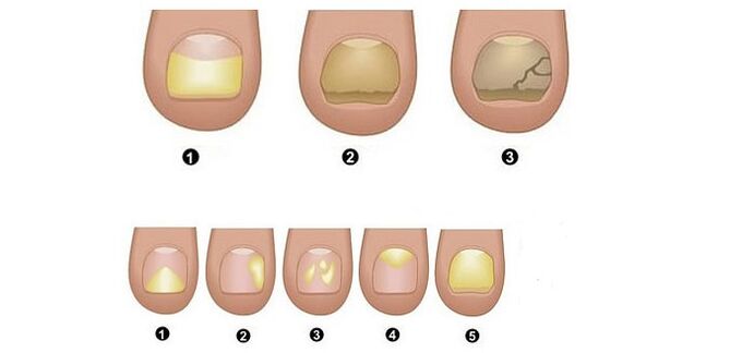 etapas e síntomas do fungo das unhas