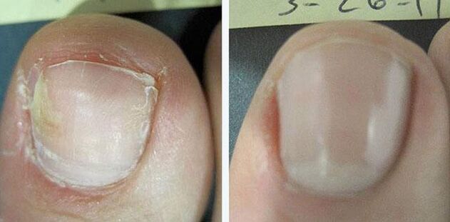 antes e despois do tratamento do fungo das unhas