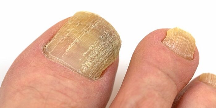 danos nas uñas con infección fúngica avanzada