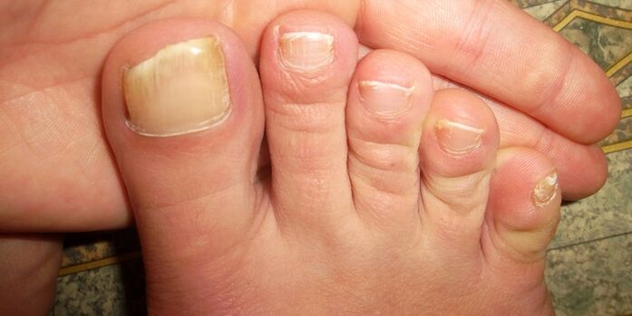 danos nas uñas dos pés con fungos