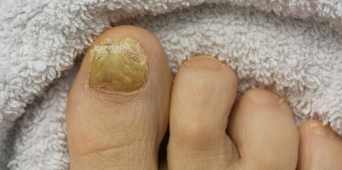 uña dos pés amarela con infección por fungos