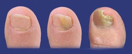 etapas de desenvolvemento do fungo nas uñas dos pés