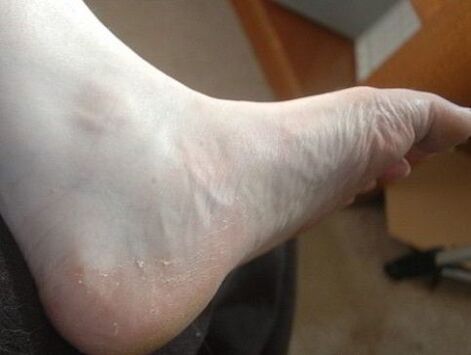 descamación do pé da perna como sinal de infección por fungos