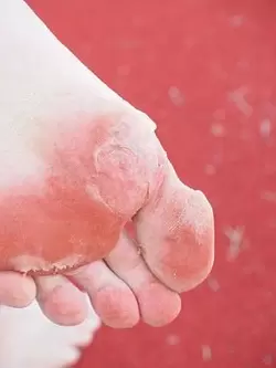 síntomas do fungo do pé